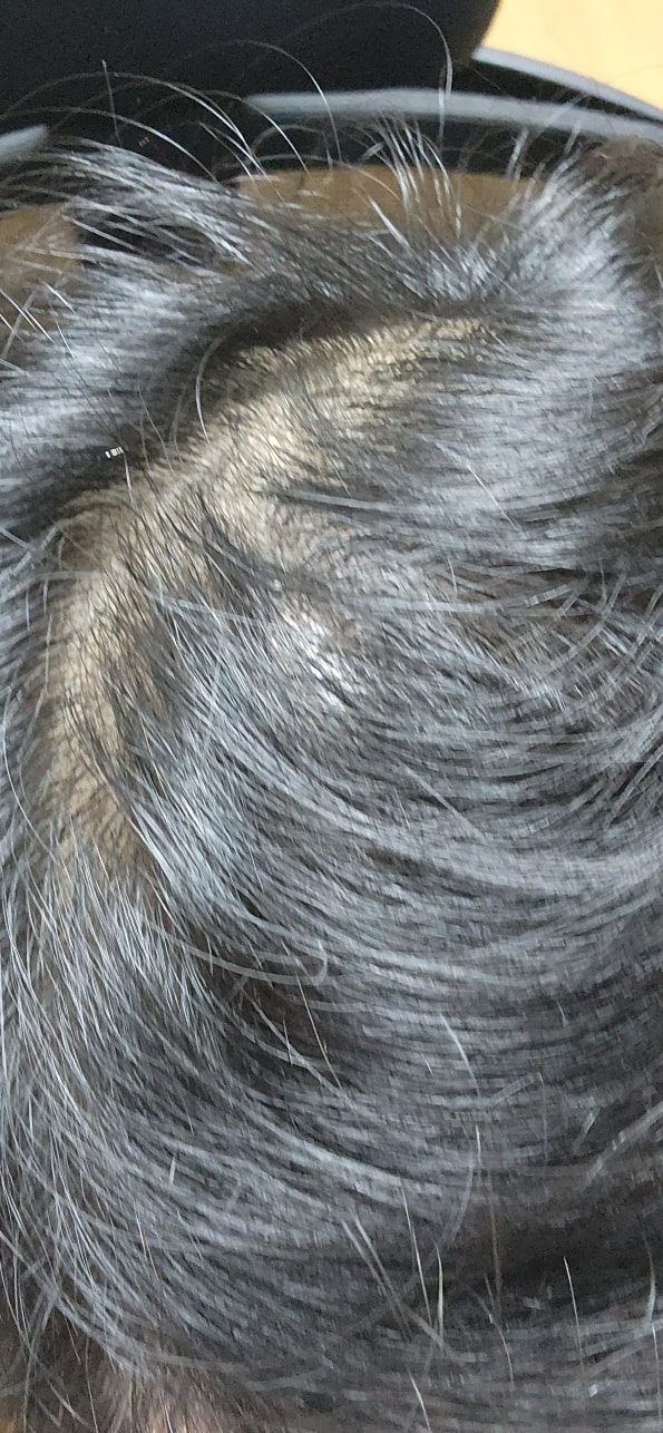 정수리가 이렇게 까지 되었는지 몰랐네요ㅠㅠ 선배님들의 조언 바랍니다