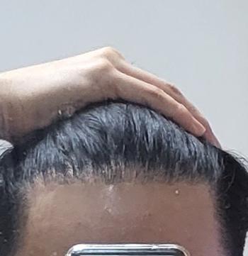비절개 2000모