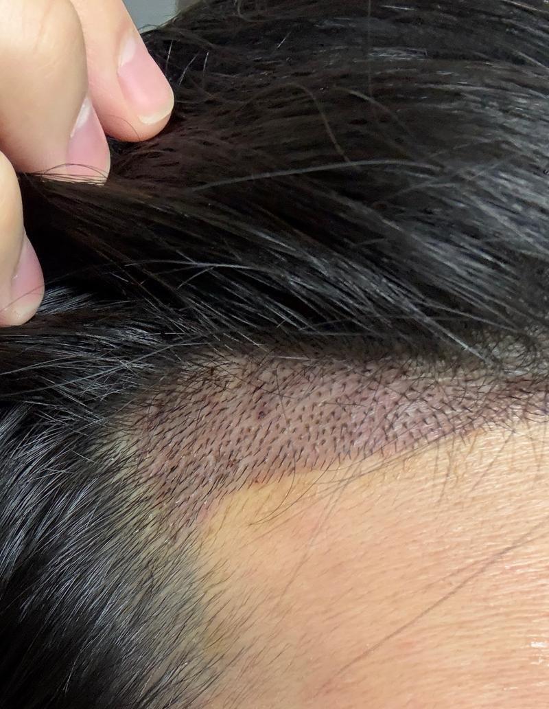 植毛4日目、ちゃんと管理しているんでしょうか？