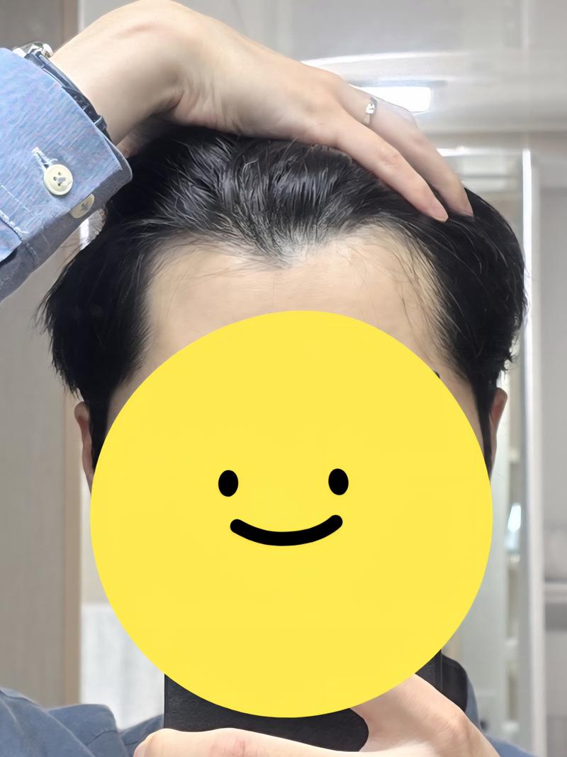 M자 모발이식 견적