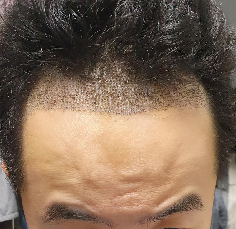 毛髪移植7日目の状況報告