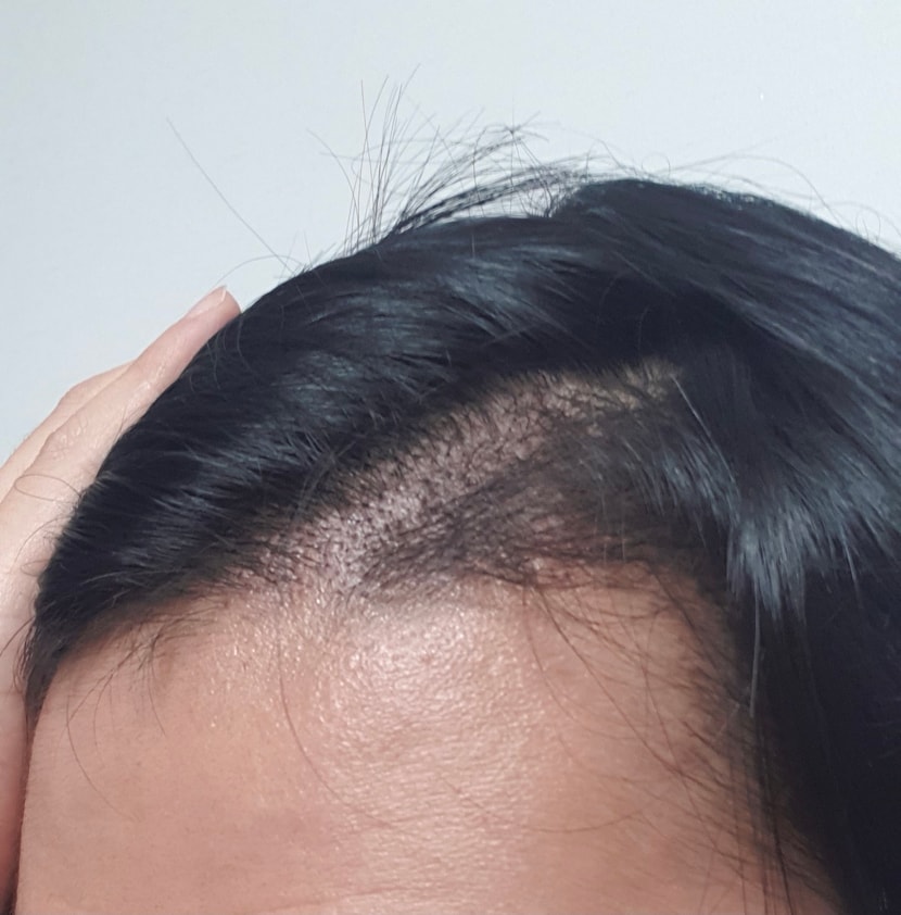 수술하고 2주 후입니다
