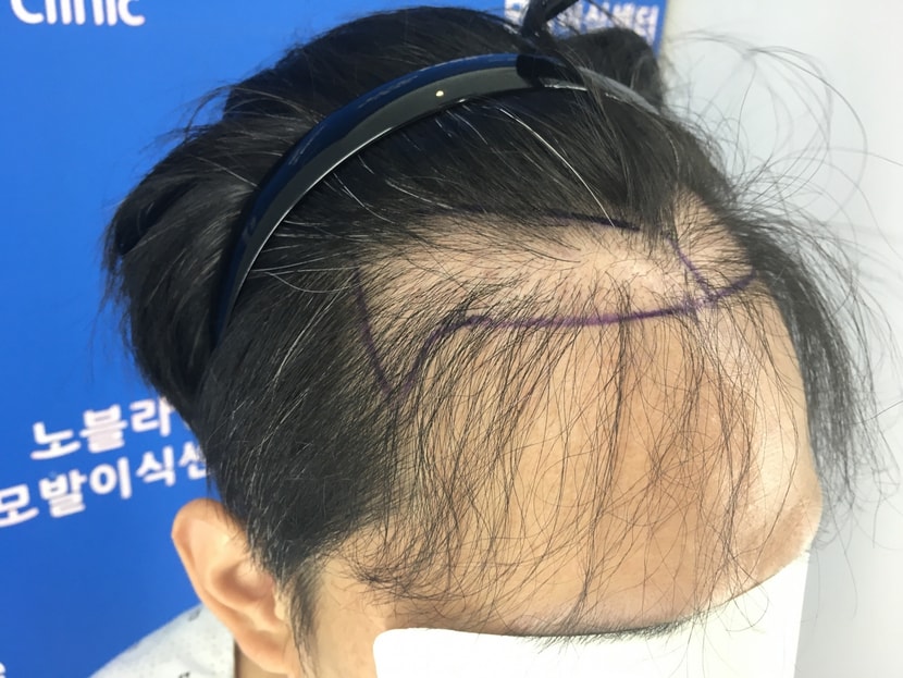 첫수술후 실패사진.(타병원서 실패후 노블라인에서 촬영)