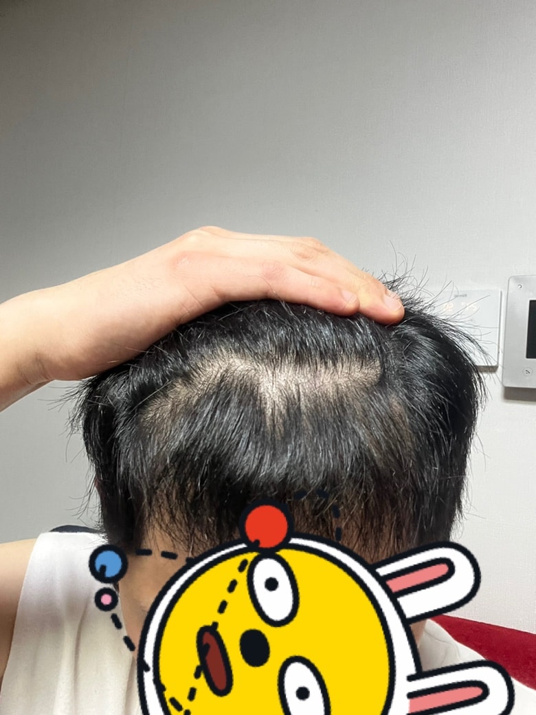 드디어 모발이식1년 <모재성성형외과의원>