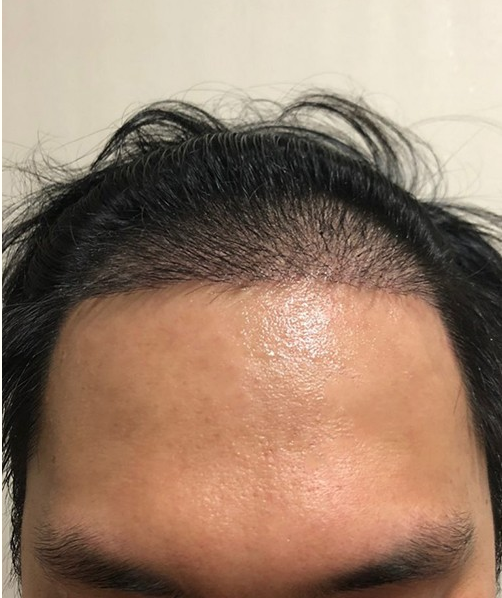 수술 14일후