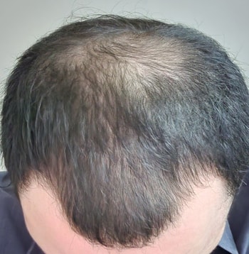 정수리 + M자탈모