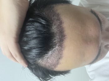 수술 10일차