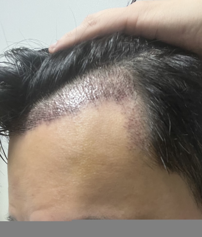 10일차(딱지제거 후)