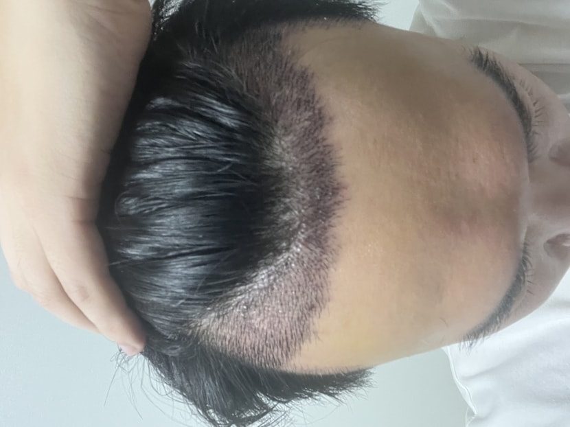 10일차(딱지제거 후)