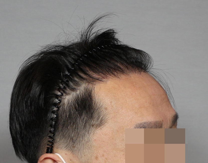수술후3