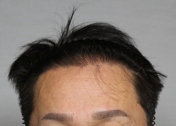 수술후1