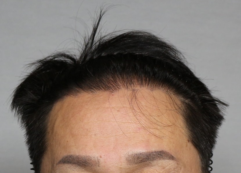 수술후1