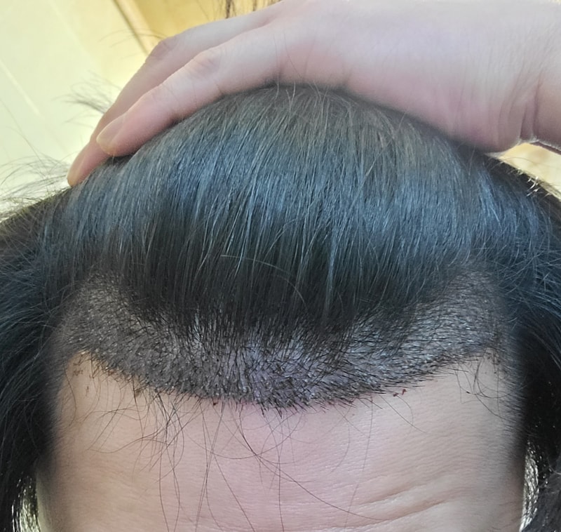 모발이식 비절개 54일차 실패한건가요??