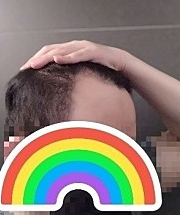 모발이식 전