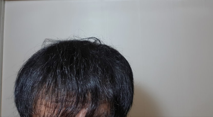 이식전 내린머리