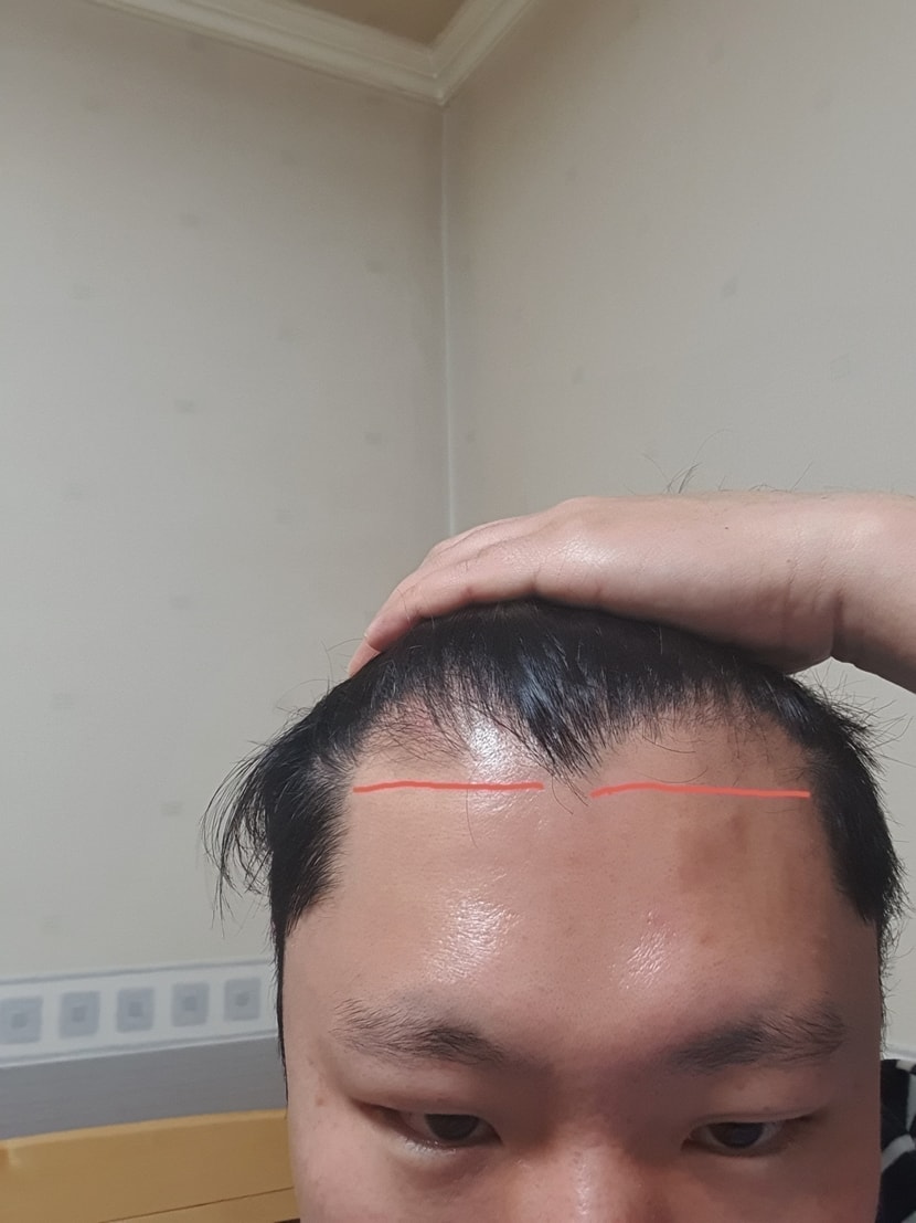 앞머리. 심고싶은라인