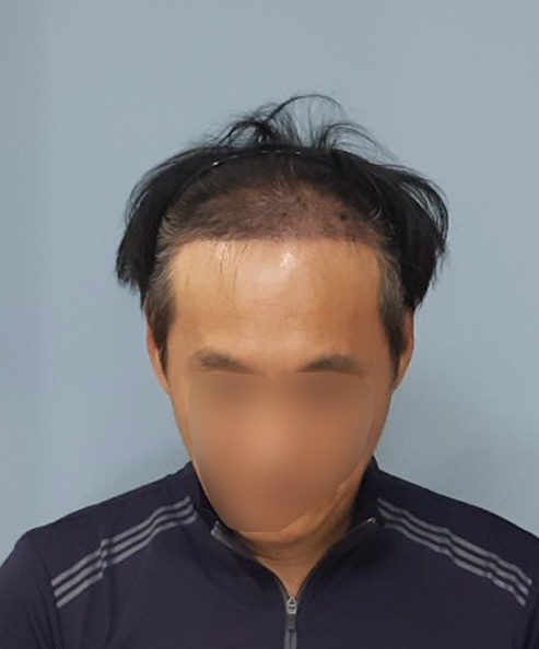 수술후 14일차