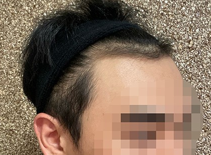 모발이식 전