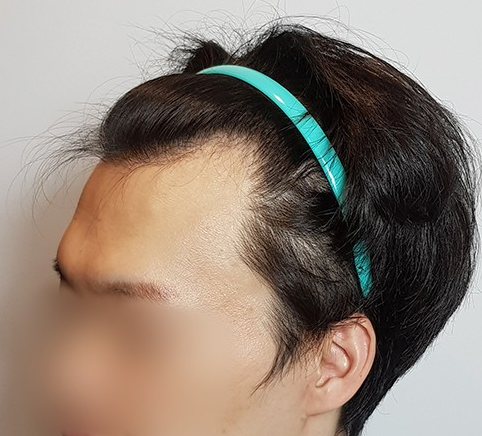 모발이식 전