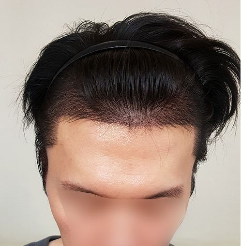 모발이식 후