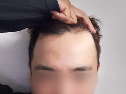 이식 전
