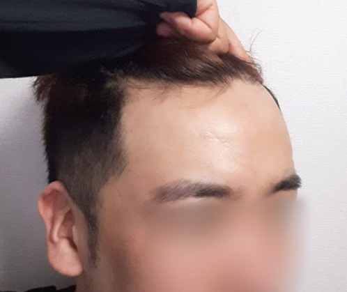 이식 전