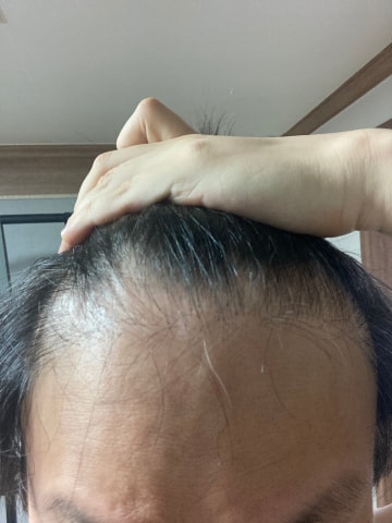 모발이식전