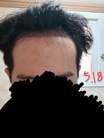 5.18