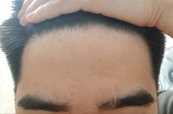 이마 라인 상태