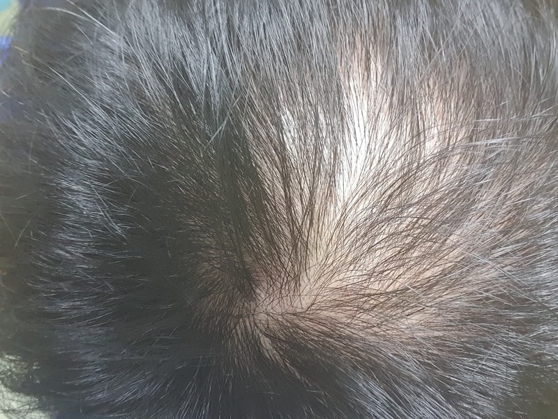 머리는 결국 심어야 끝나는것인가