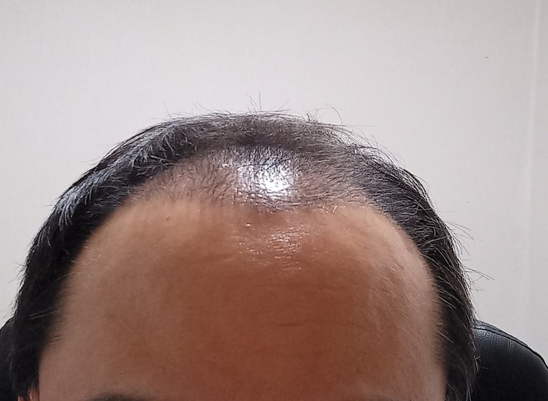 Moaman Clinic incision 5,500 Mo 12 months late