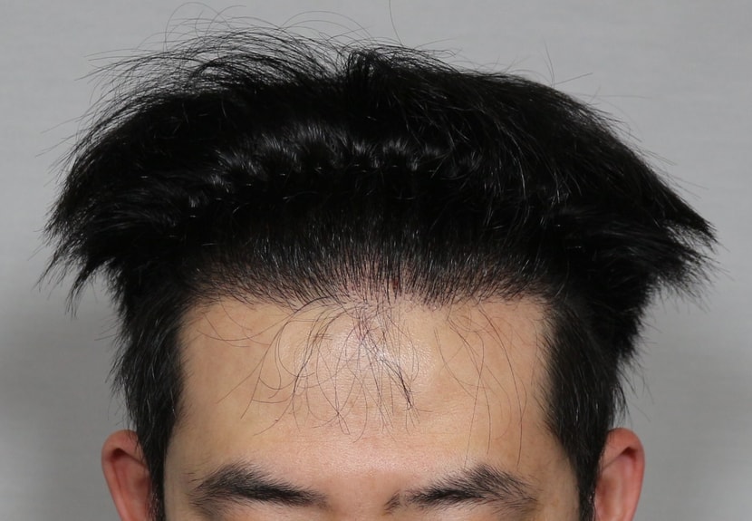 수술후