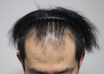 수술전