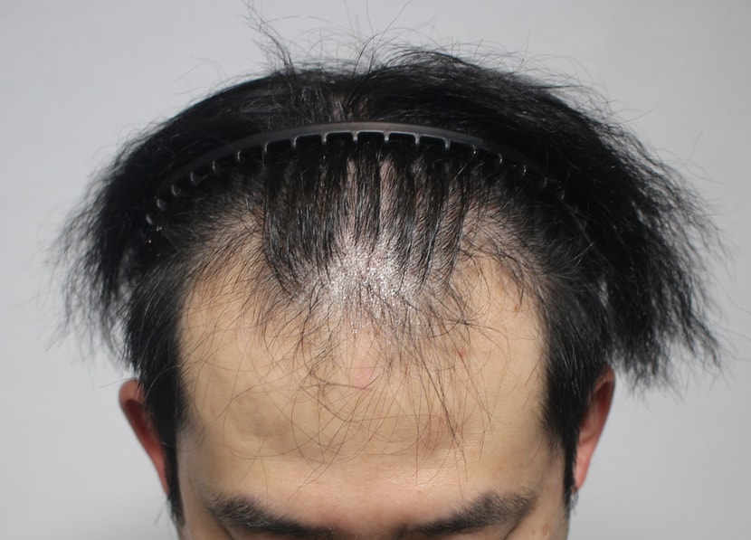 수술전