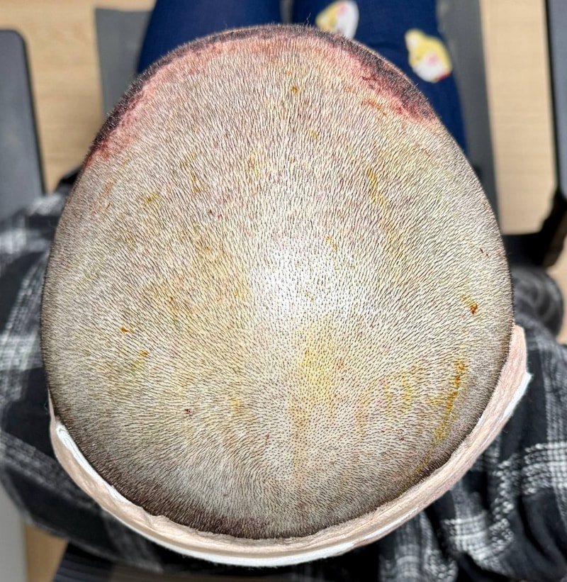 非切開植毛1ヵ月経過記録(feat. ジェネリックデュタステリド+ミノキシジル)