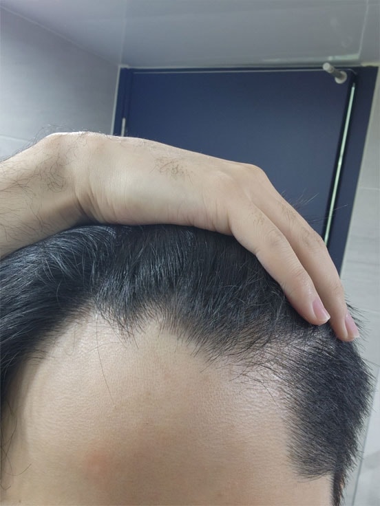수술전이구요