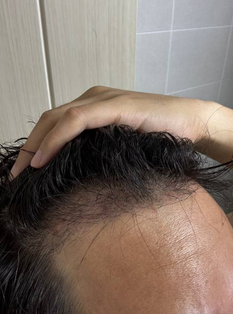 Dana 1900 毛囊大量移植 4个月克服黑暗期