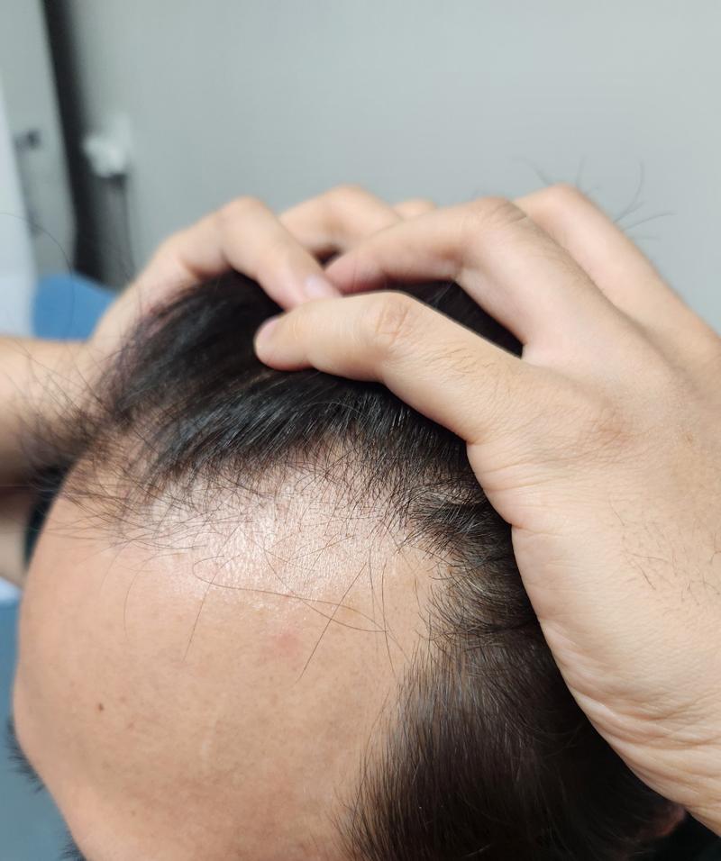 1900株 ヘアライン手術3日目 体験談