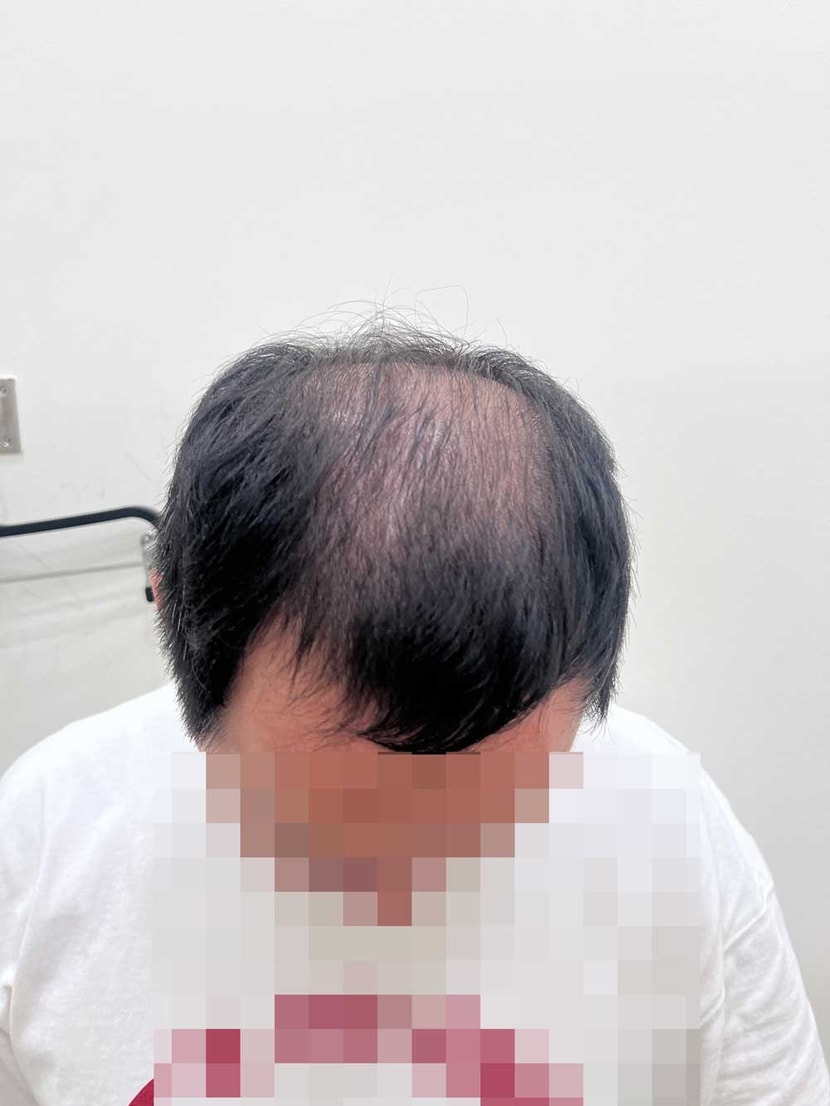 수술전