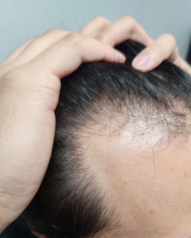 多娜整形外科1900 毛囊 发际线移植.. 不如当兵的黑暗期