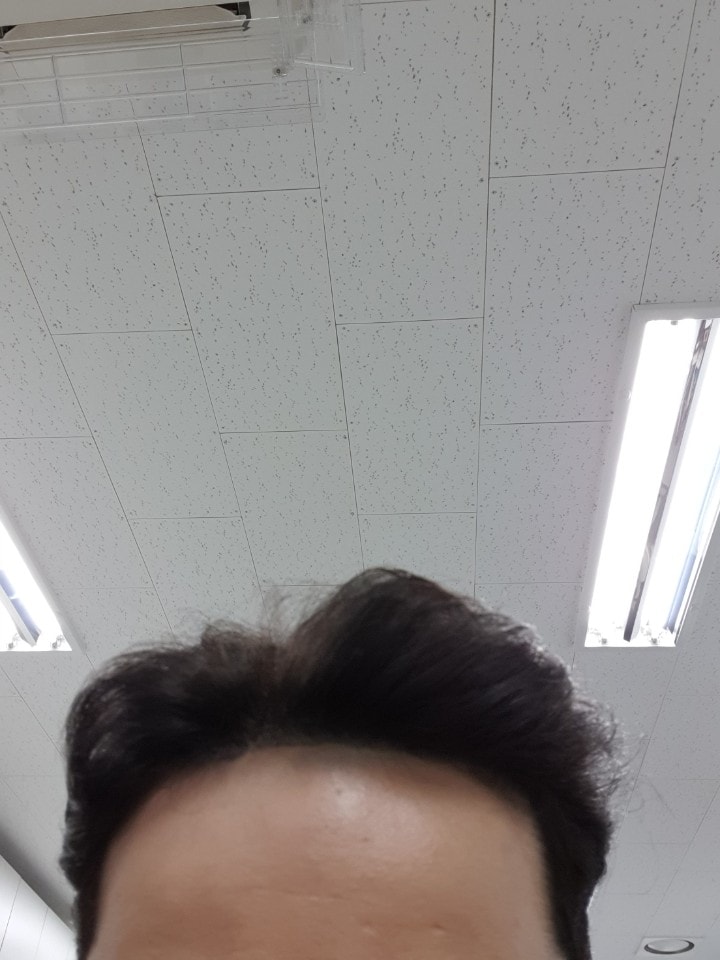 M자 수술 9개월차