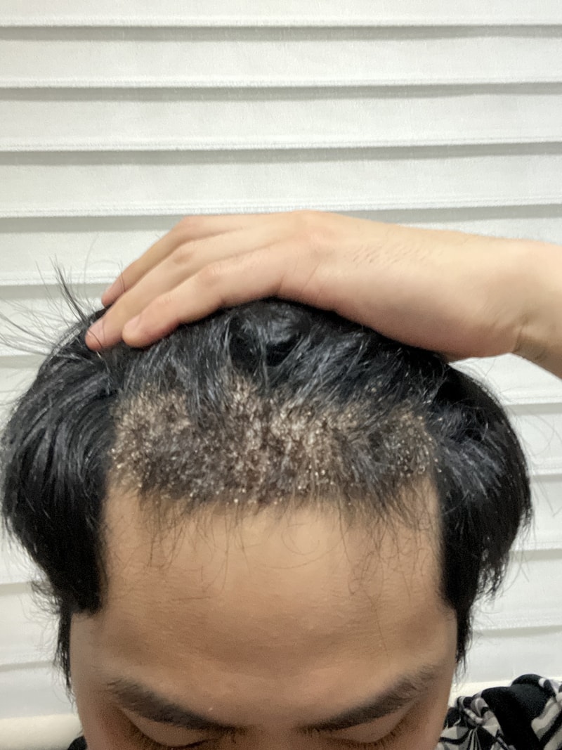 毛发移植第 4 个月（毛在成整形外科医院）