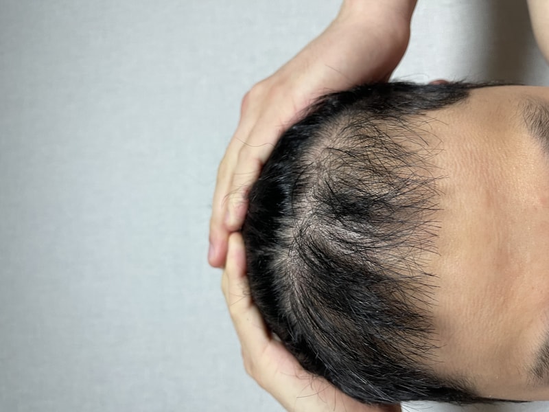 모재성성형의원 모발이식 8개월차 후기