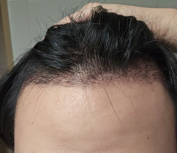 수술 약 한달차때입니다