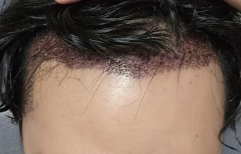 수술 이틀차때입니다