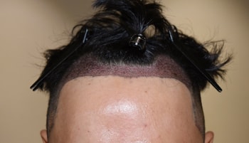 수술 후 디자인