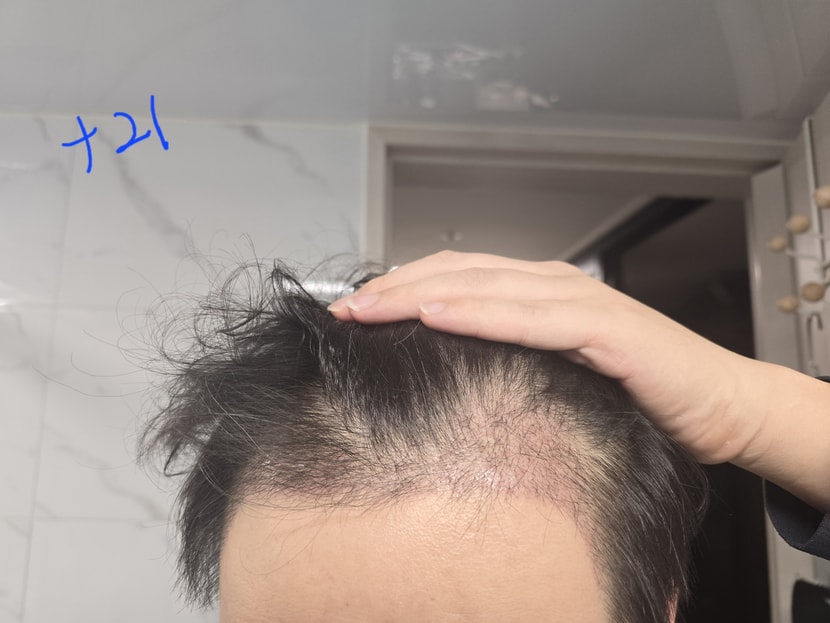 이식 21일