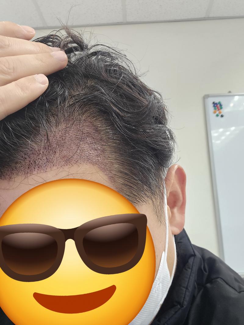 모발이식 후 21일차 암흑기 시작인듯요