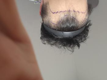이식전