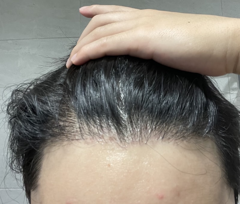 毛髪移植